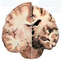 cerebro alzheimer